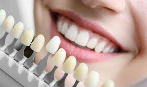 Veneers